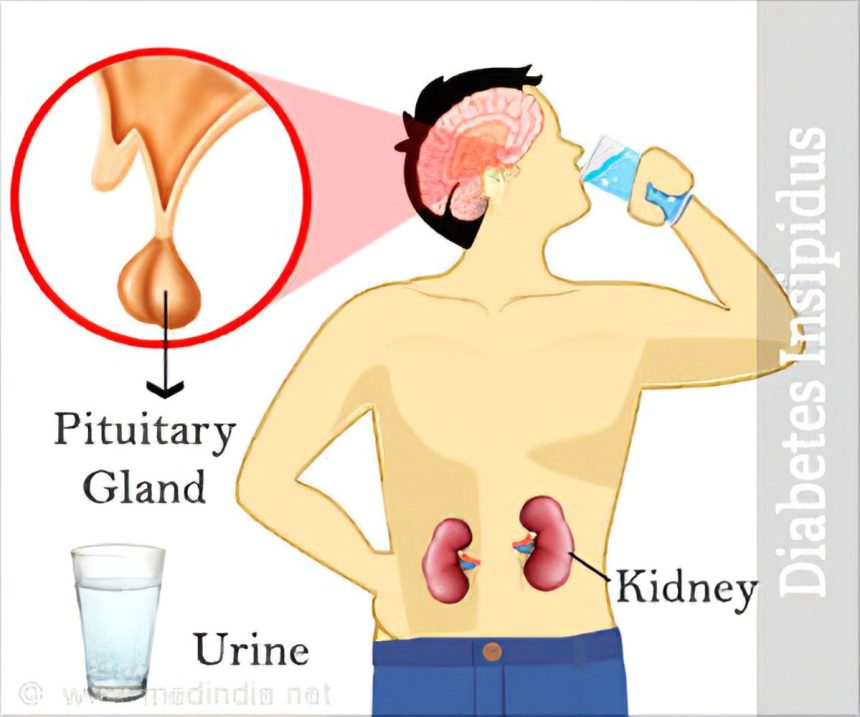 Deciphering Diabetes Insipidus: Understanding Symptoms